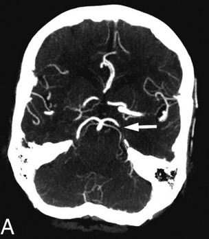  Церебральная КТ-ангиография: стрелкой указана окклюзия левой задней мозговой артерии