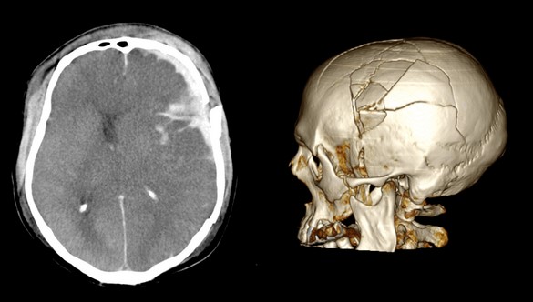 Перелом черепа на КТ