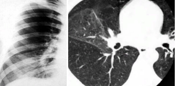 Правосторонняя среднедолевая пневмония на рентгеновском снимке и компьютерной томограмме