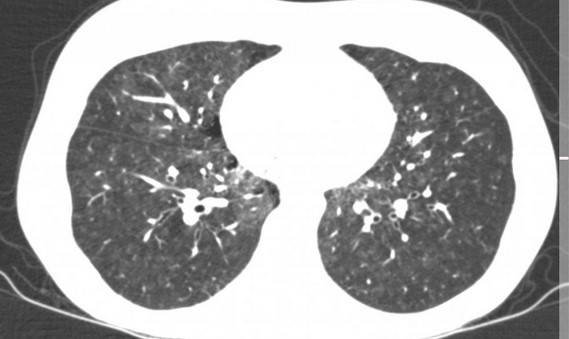 КТ-изображение получено у пациентки с идиопатической легочной гипертензией