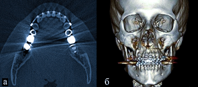 Артефакты от зубных конструкций на КТ