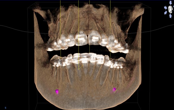 3D-реконструкция зубов с брекетами, полученная в результате компьютерной томографии