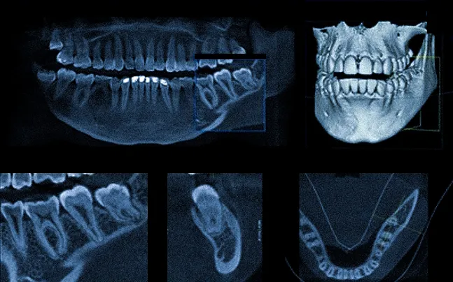 Серия компьютерных томограм зубных рядов