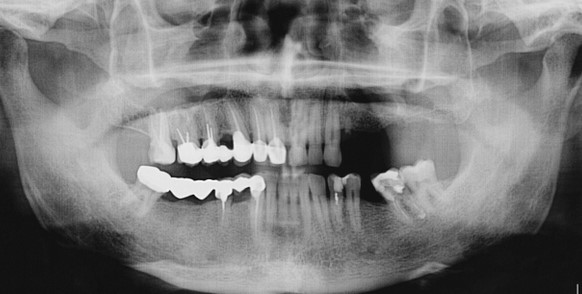 Снимок, полученный при компьютерной томографии: видно наличие зубных коронок