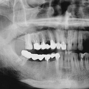 Можно ли делать КТ с зубными имплантами
