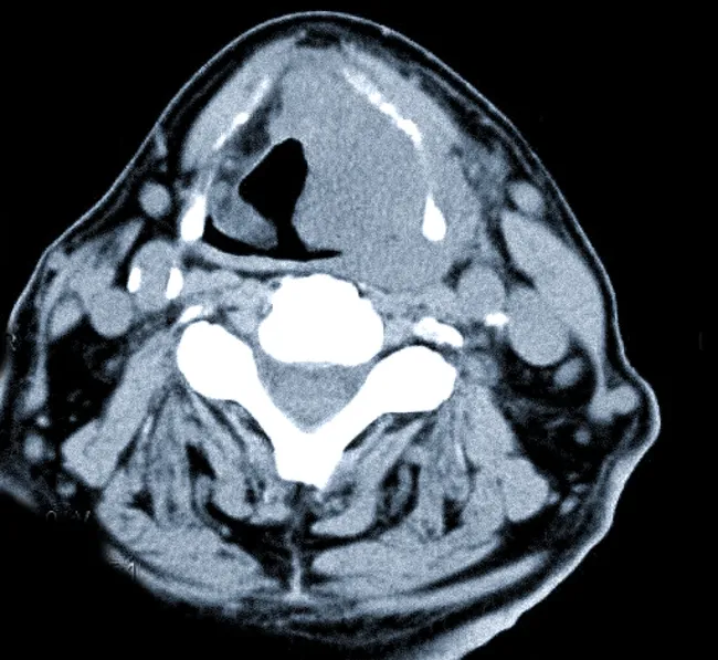 Опухоль щитовидной железы на компьютерной томографии