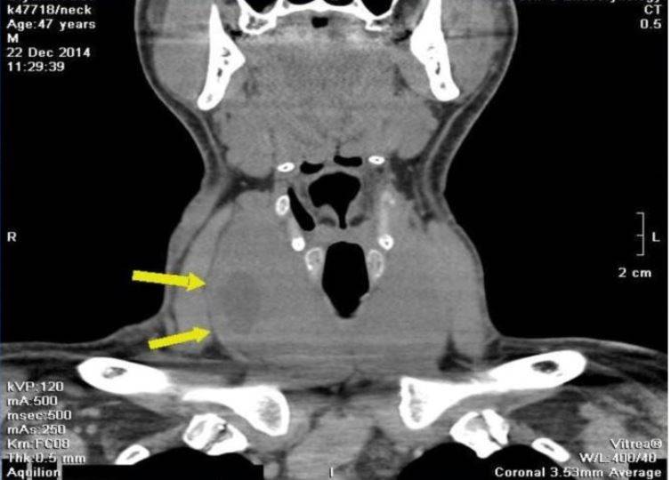Узловой зоб щитовидной железы на компьютерной томограмме (очаговые изменения указаны стрелками)