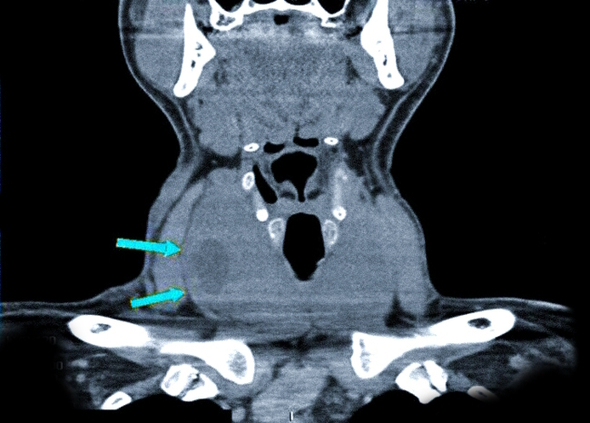 Узловой зоб щитовидной железы на компьютерной томограмме (очаговые изменения указаны стрелками)