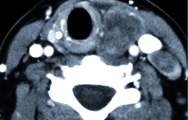 Опухоль паращитовидной железы на компьютерной томограмме