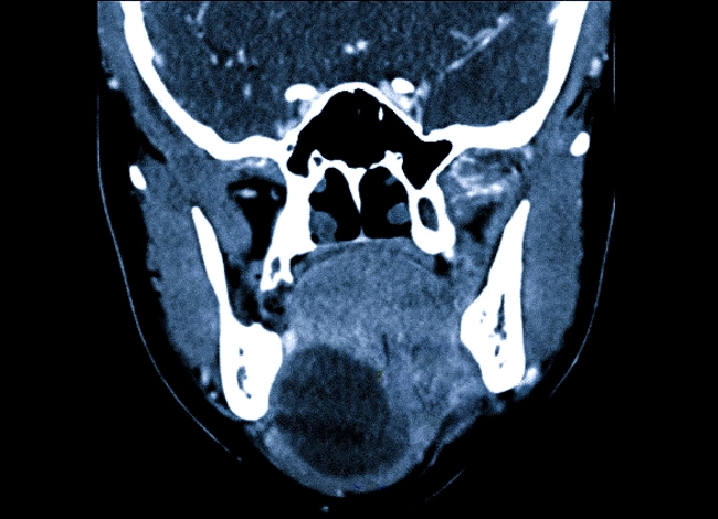 Увеличенная слюнная железа на КТ