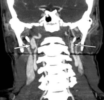 Коронарное изображение МСКТ демонстрирует саккулярный затек контраста (толстая стрелка) из правой внутренней сонной артерии (псевдоаневризма). Левая сонная артерия (тонкая стрелка) не повреждена.