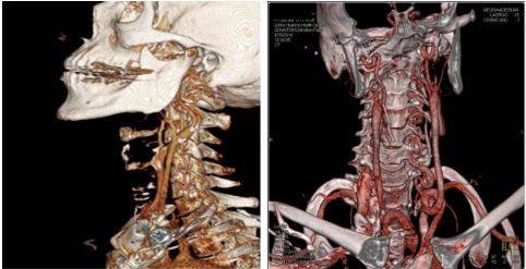 3D-реконструкция артерий шеи при КТА
