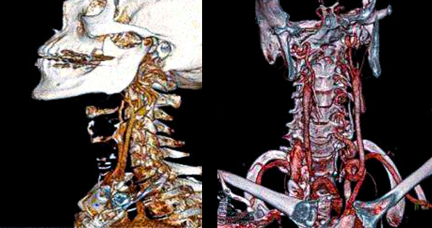 3D-реконструкция артерий шеи при КТА