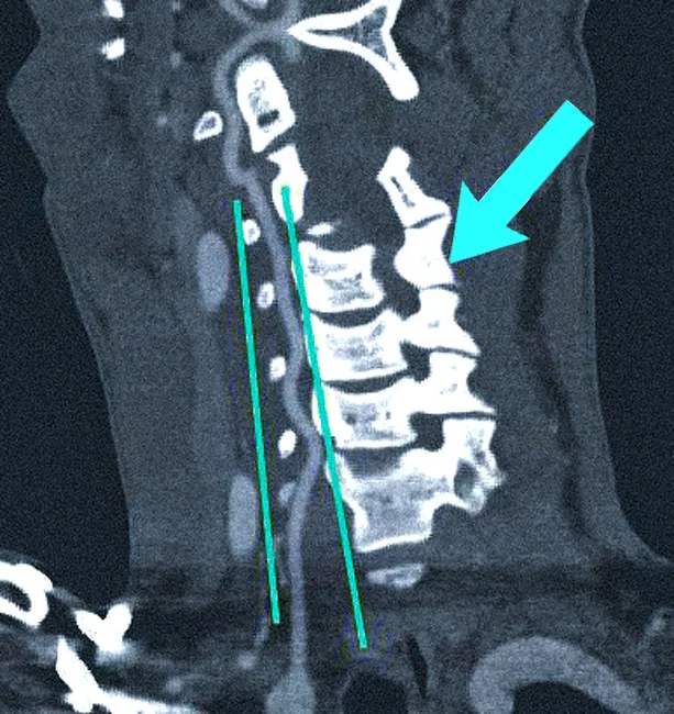 КТ-ангиограмма кровеносных сосудов в области шеи. Позвоночная артерия находится между вертикальными линиями. Стрелка указывает на позвоночник