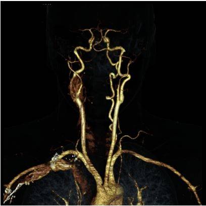 КТ сосудов шеи позволяет детально оценить ход магистральных артерий