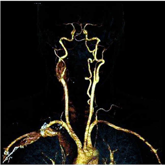 КТ сосудов шеи позволяет детально оценить ход магистральных артерий