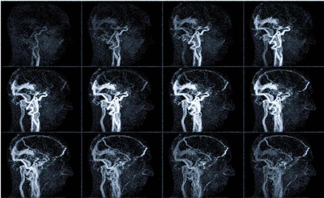 КТ сосудов шеи показывает артерии, питающие головной мозг
