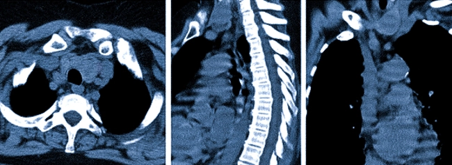 КТ средостения, аксиальная, сагиттальная и фронтальная проекции