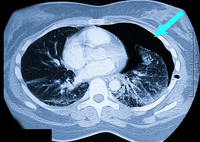 Пневмоторакс на снимке КТ