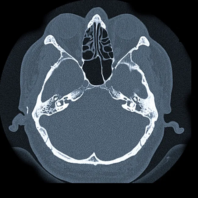 Снимок (томограмма) височных костей в осевой проекции
