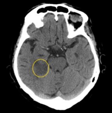 На снимке, полученном при компьютерной томографии, кругом обведена зона инсульта в бассейне средней мозговой артерии справа