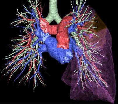 Возможности 3D-реконструкции КТ легочной артерии и ее ветвей
