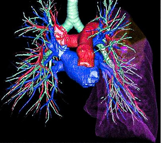 Возможности 3D-реконструкции КТ легочной артерии и ее ветвей