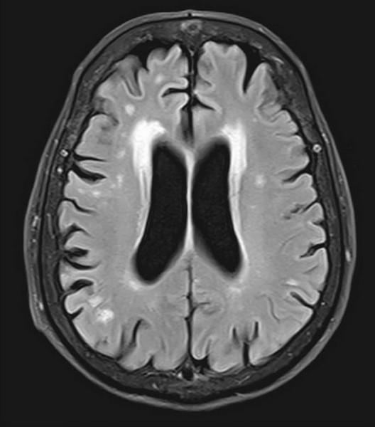 Лейкоареоз при МРТ головного мозга