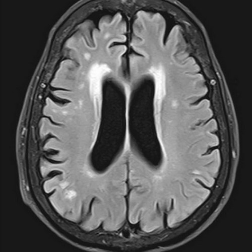 Лейкоареоз при МРТ головного мозга