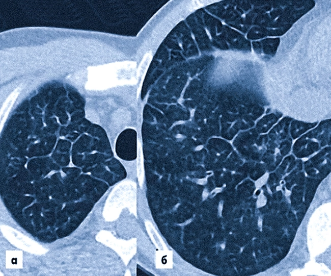 Лимфогенный канцероматоз легких на КТ что это