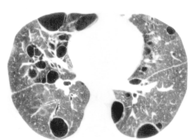  КТ-сканирование органов грудной клетки