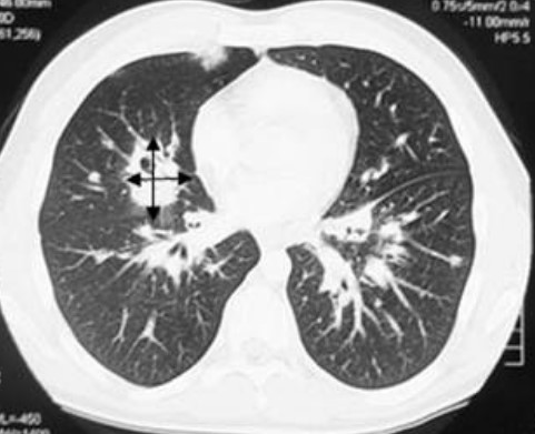Слева - рентген, справа - КТ легких при лимфопролиферативной болезни
