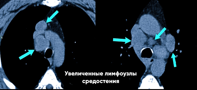 Увеличение лимфоузлов средостения у пациента с саркоидозом