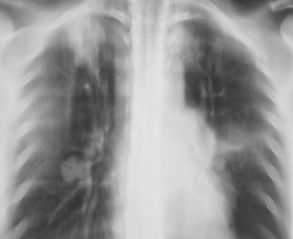 Туберкулез легких на снимке линейной томографии