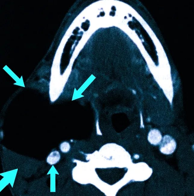  Липома мягких тканей шеи на КТ