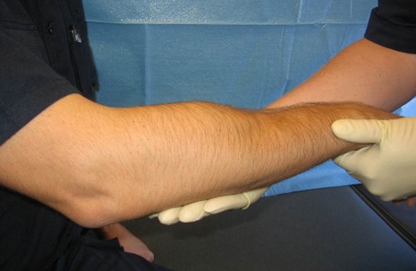 Внешний вид руки пациента с псевдоартрозом