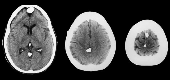 Менингиома головного мозга на КТ