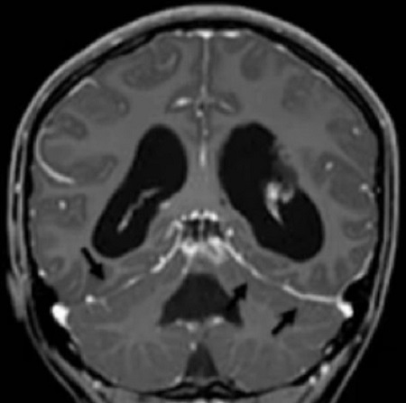 Признаки менингита на МР-скане головы