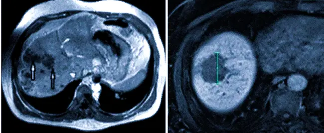 Первичный рак печени и отсев опухоли колоректального рака на МРТ