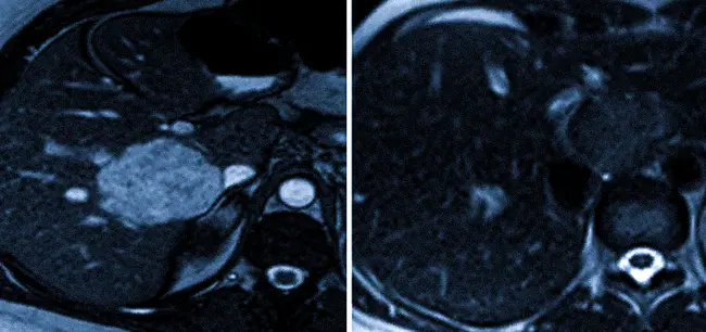 МРТ сосудистая доброкачественная опухоль печени