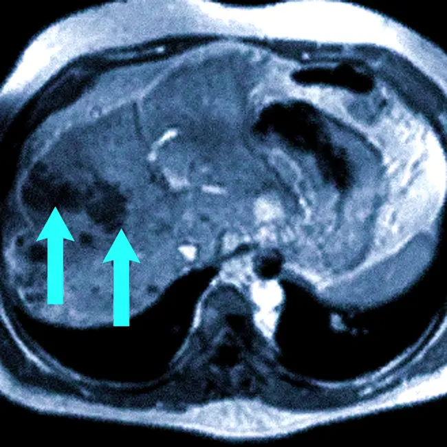 Метастазы на МРТ печени