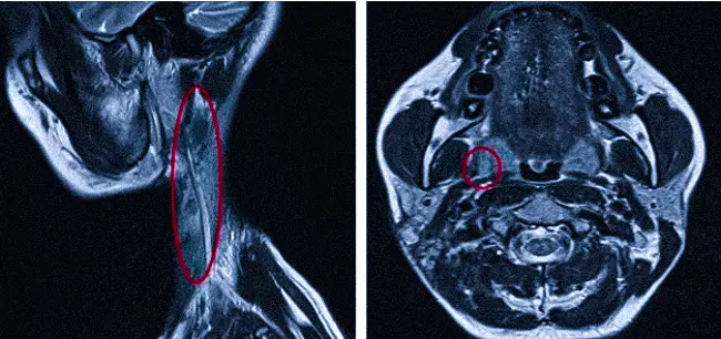 МРТ показывает метастазы в лимфоузлах