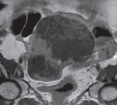 Как выглядят метастазы в лимфоузлах на МРТ снимках