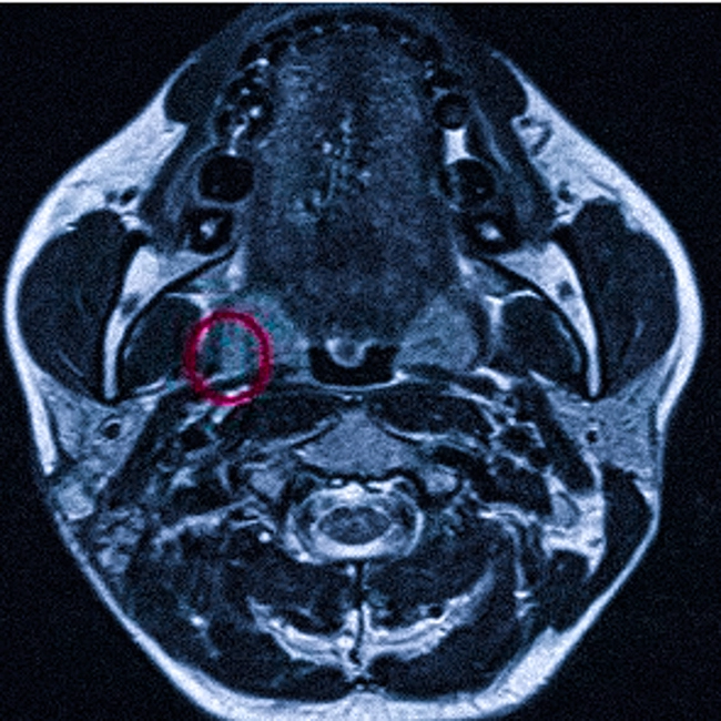 Метастазы в лимфоузлах на МРТ