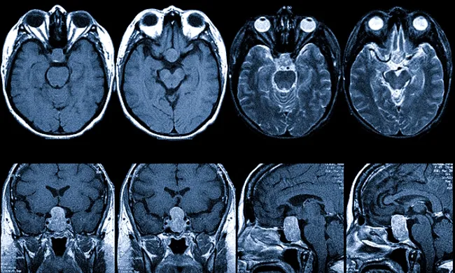 Микроаденома гипофиза на МРТ