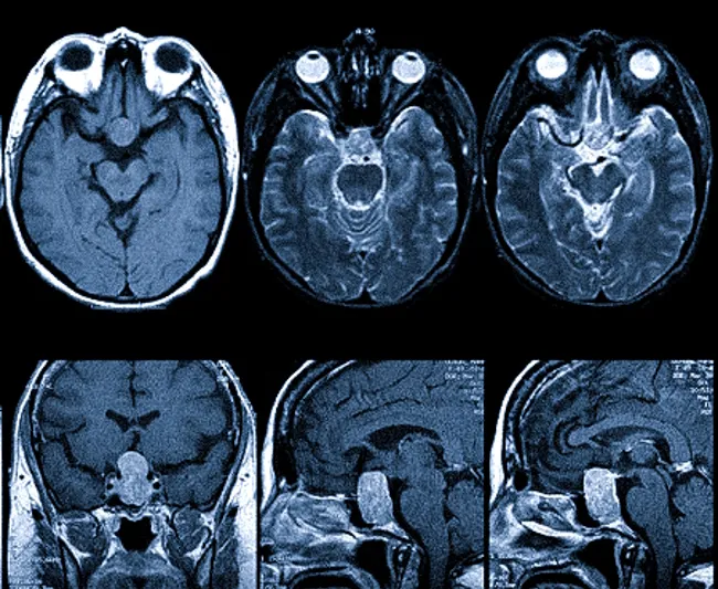 Микроаденома гипофиза на МРТ
