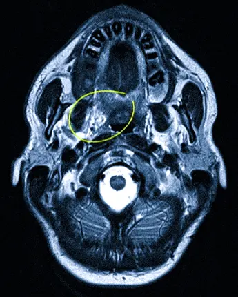 Опухоль мягких тканей полости рта на снимке МРТ