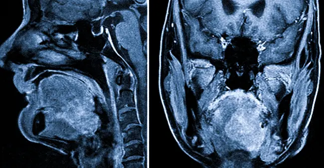 Карцинома ротоглотки, снимки МРТ в боковой и поперечной проекциях