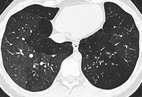 Томограмма больного бронхиолитом: зоны мозаичной перфузии в нижних отделах с обеих сторон