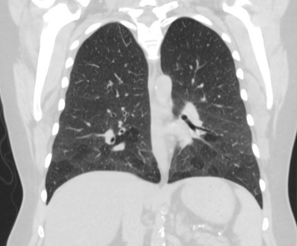 Рентгенография или КТ легких при мозаичной перфузии